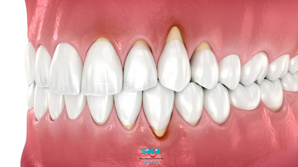 What Causes Gum Recession?