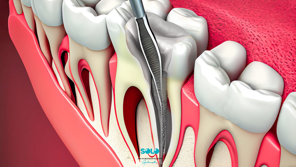 Başarısız Kanal Tedavisi Belirtileri