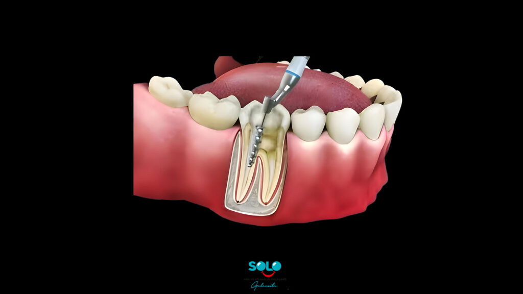  Root Canal Treatment