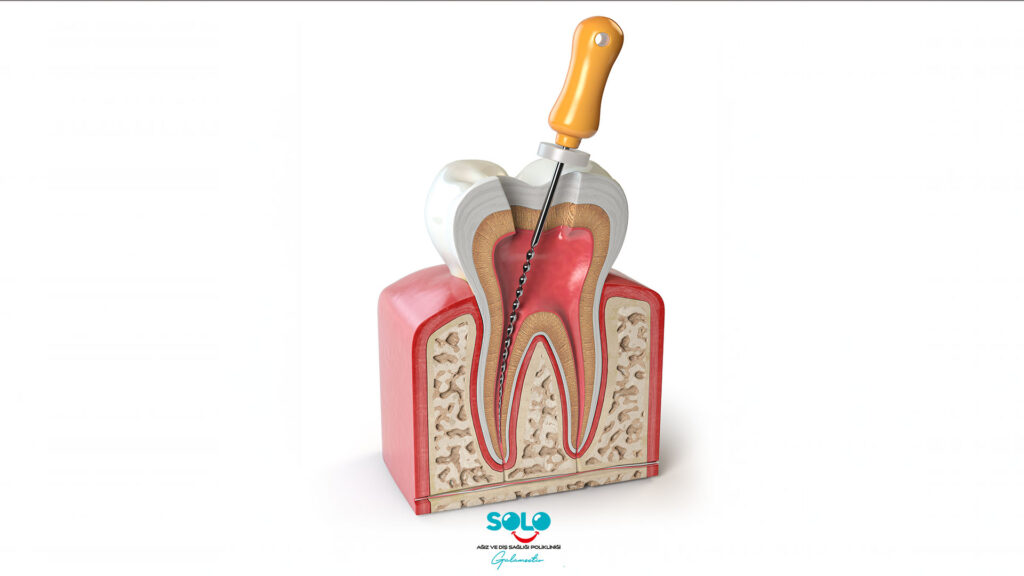  Root Canal Treatment