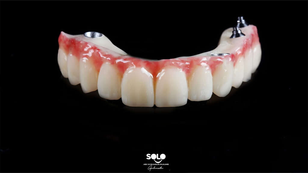 Implant Supported Prosthesis