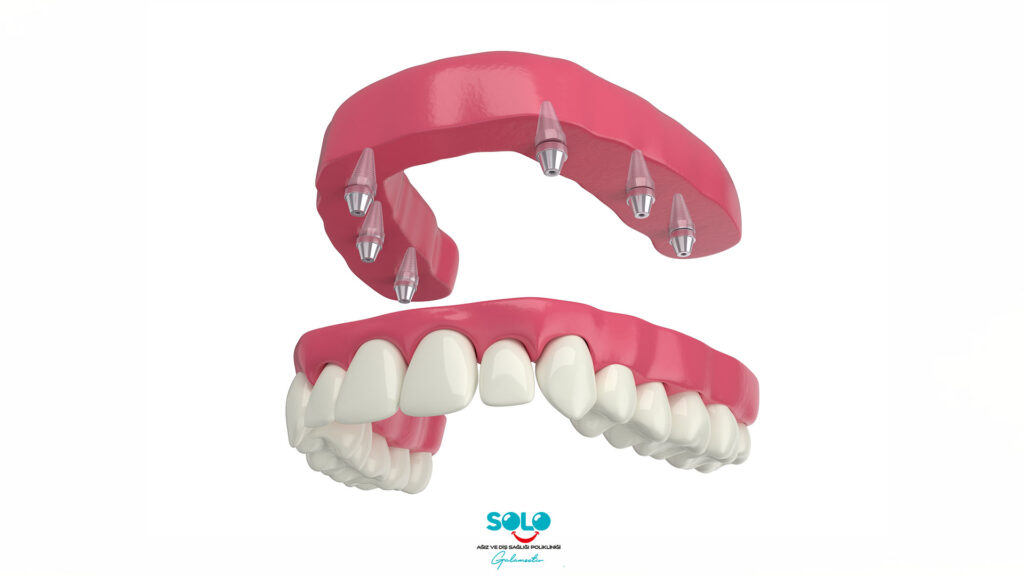 Implant Supported Prosthesis