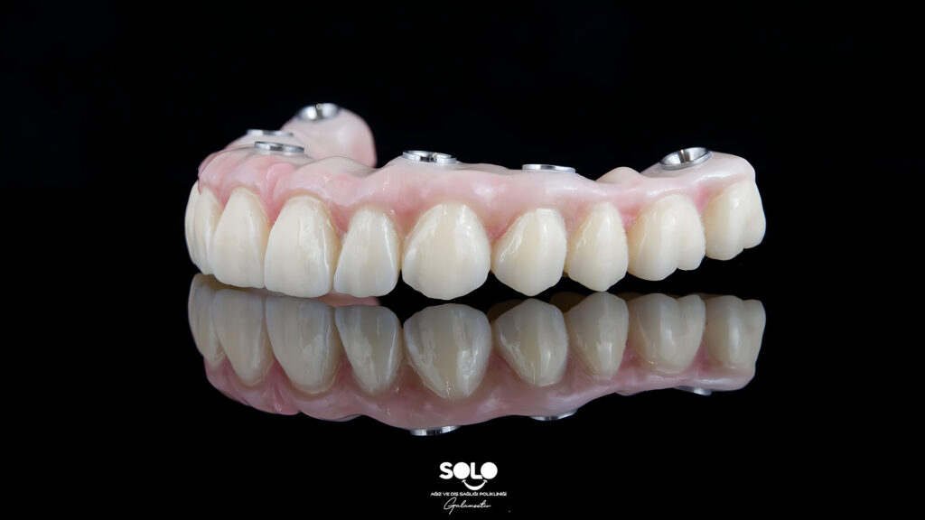 Implant Supported Prosthesis