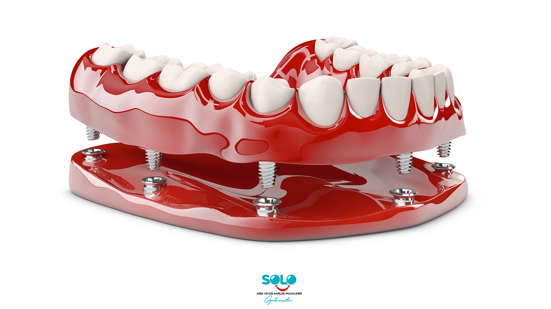 İmplant Üstü Protez