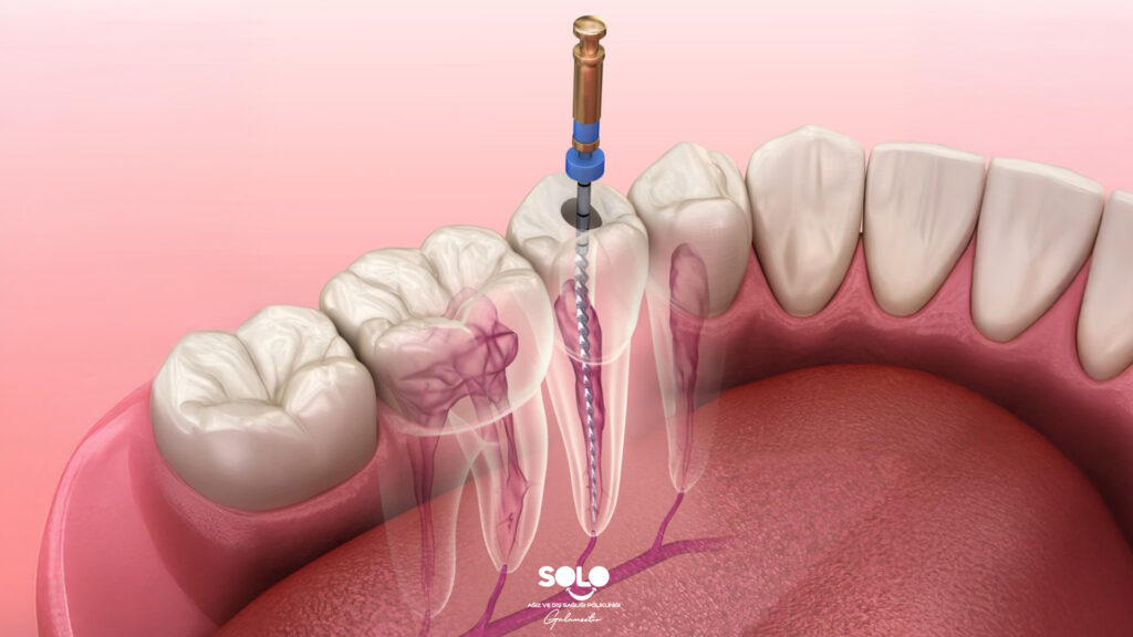 Kanal Tedavisi Sonrası Ağrı