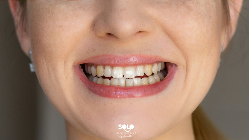 White Spots on Teeth