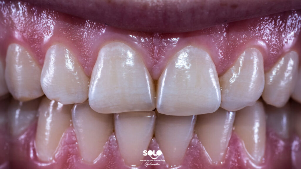 White Spots on Teeth