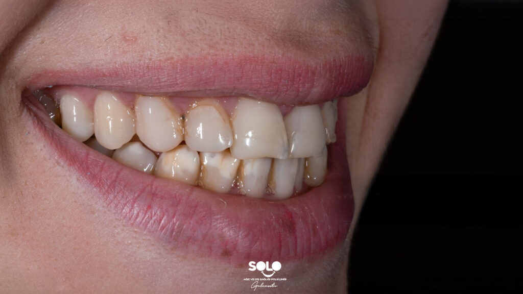 White Spots on Teeth