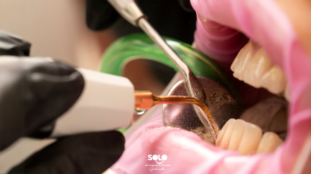 How to Clean Teeth Tartar