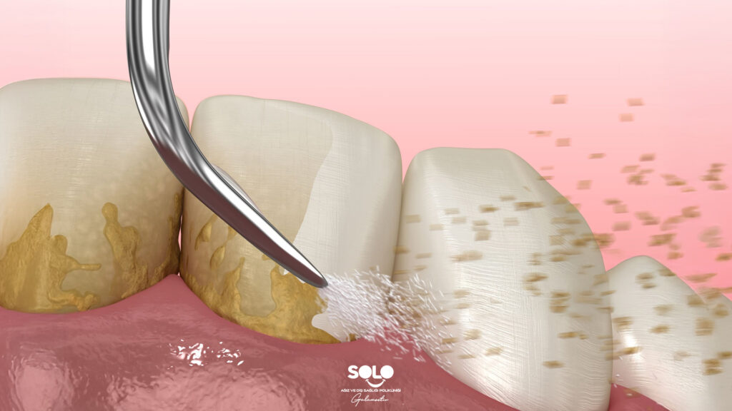 How to Clean Teeth Tartar