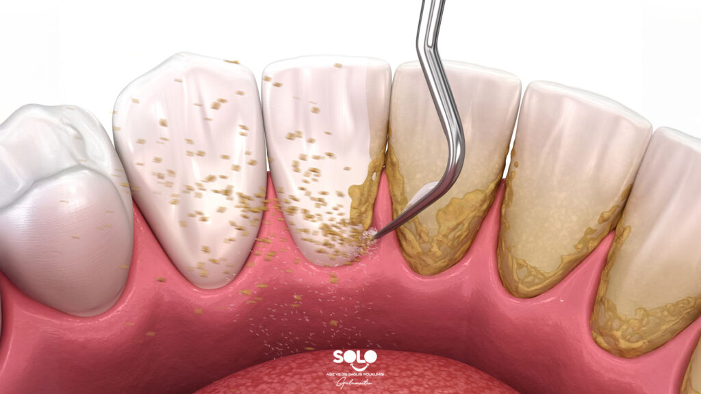 How to Clean Teeth Tartar