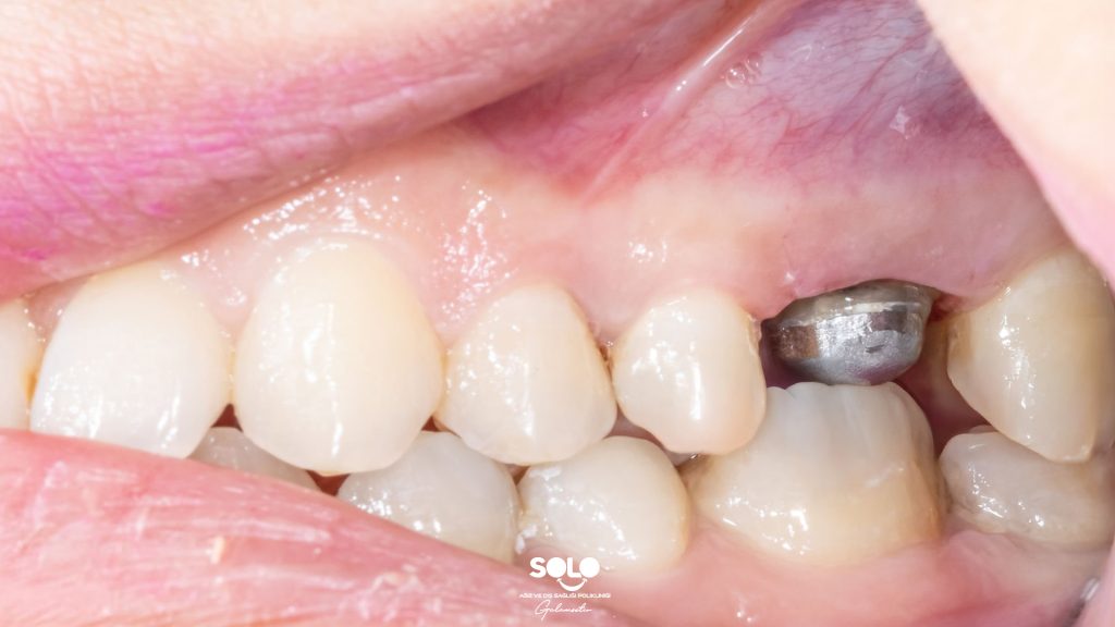 Seamless Implant