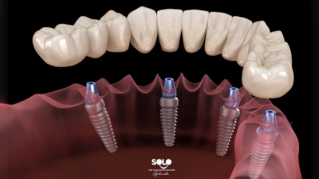 Seamless Implant