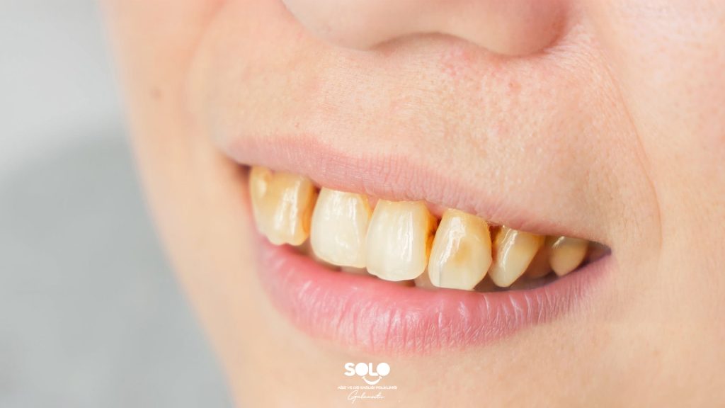 What Causes Yellowing of Teeth