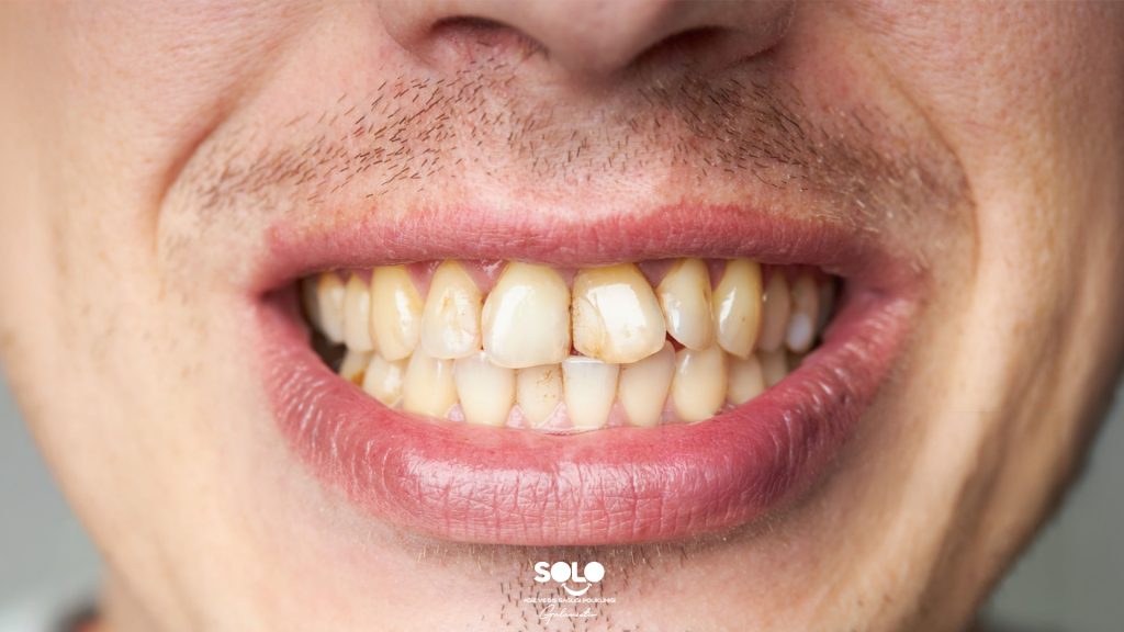 What Causes Yellowing of Teeth