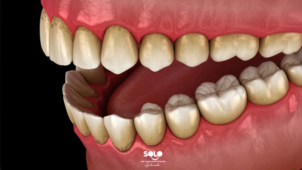 What Causes Yellowing of Teeth