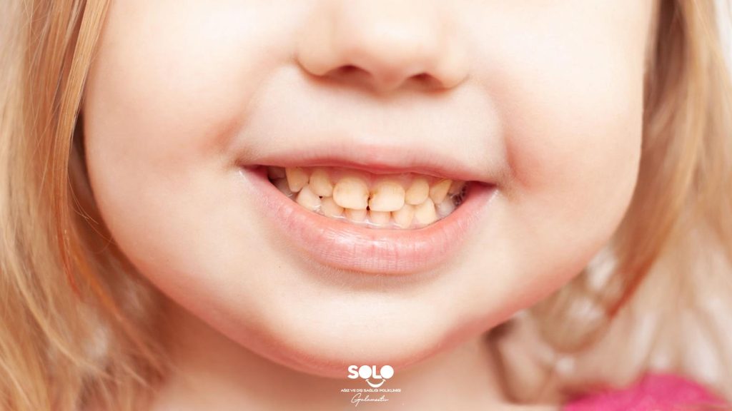 Brown Stains on Teeth