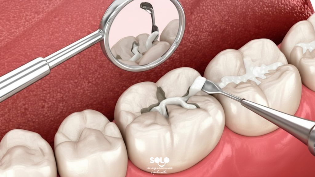 What is Fissure Sealant