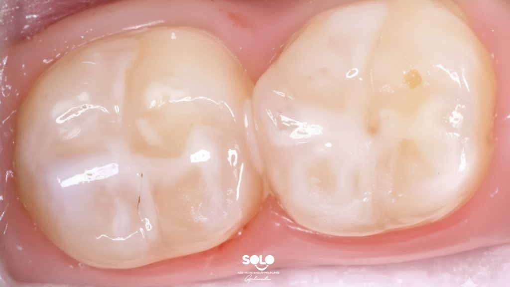 What is Fissure Sealant