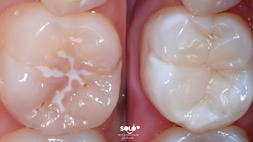 What is Fissure Sealant