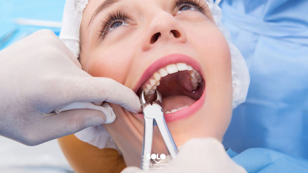 What to Do After Tooth Extraction