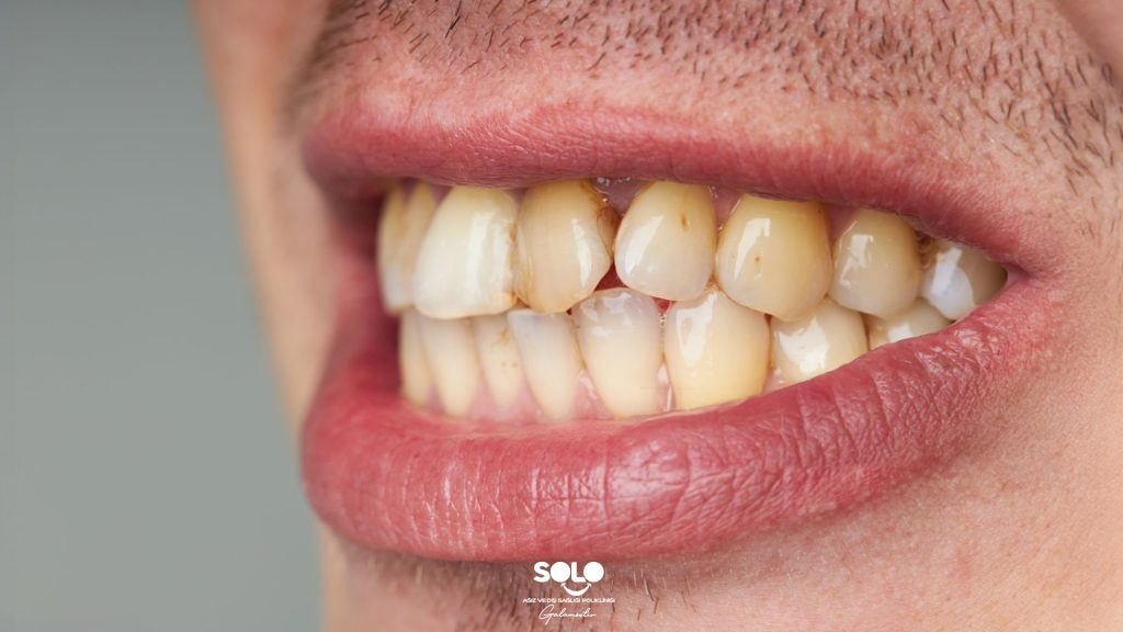 Causes of Yellowing Teeth