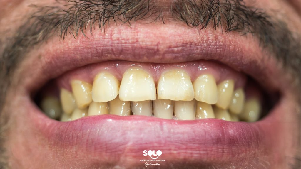 Causes of Yellowing Teeth