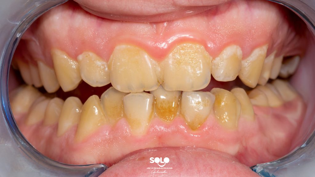 Diş Sararması Nedenleri