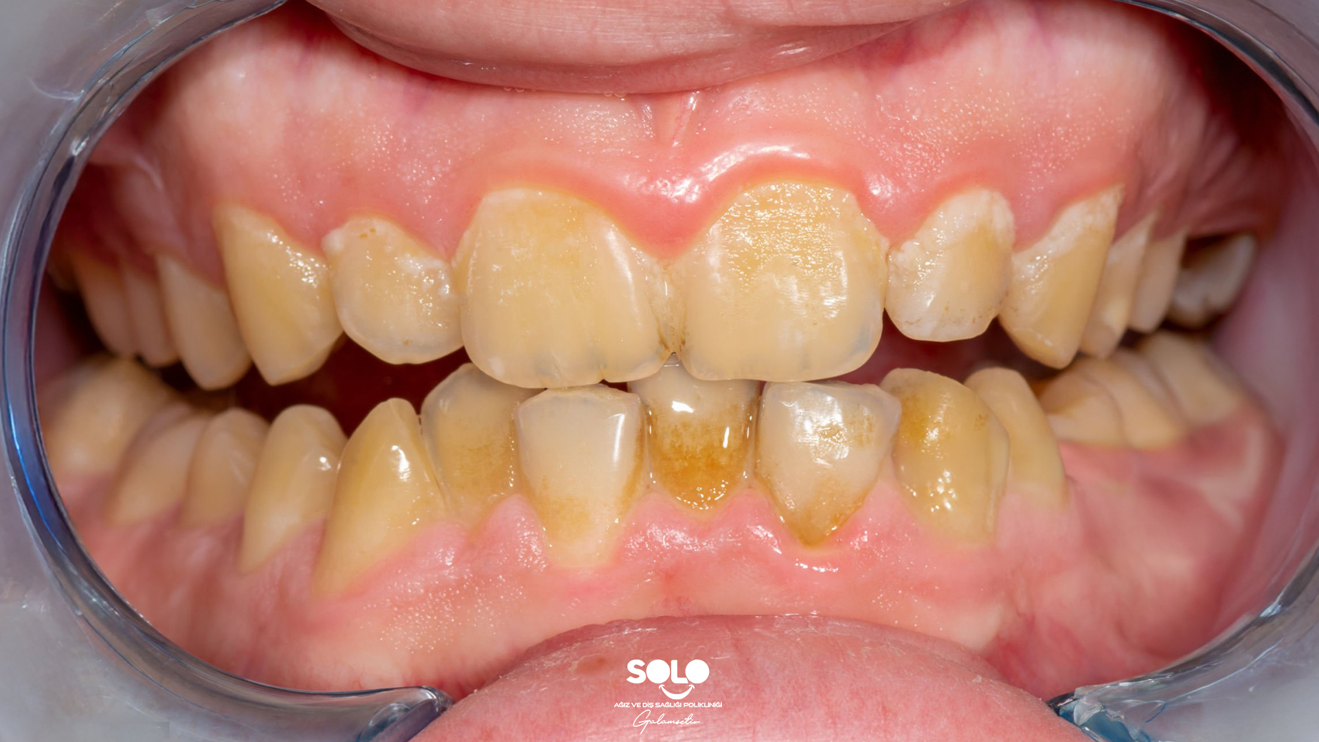 Diş Sararması Nedenleri