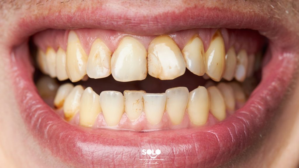 Causes of Yellowing Teeth