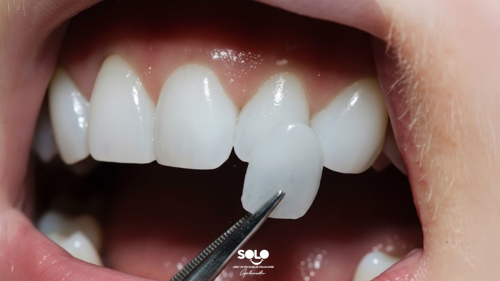 Lamine Diş Kaplama Nedir