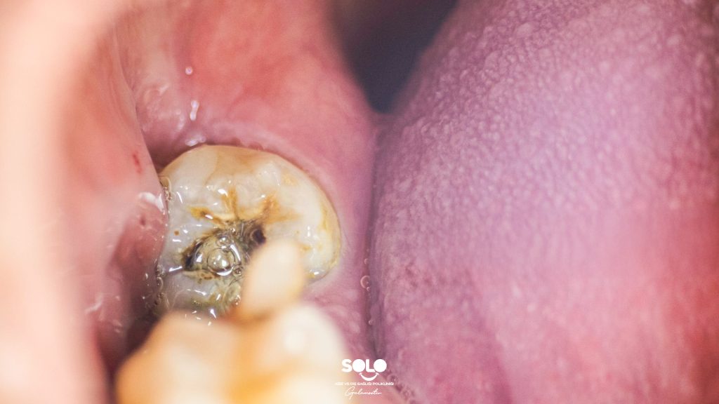 How to Ease a Toothache from Decay