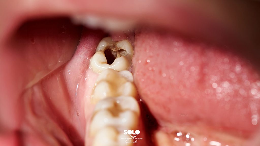 Çürük Diş Ağrısı Nasıl Geçer