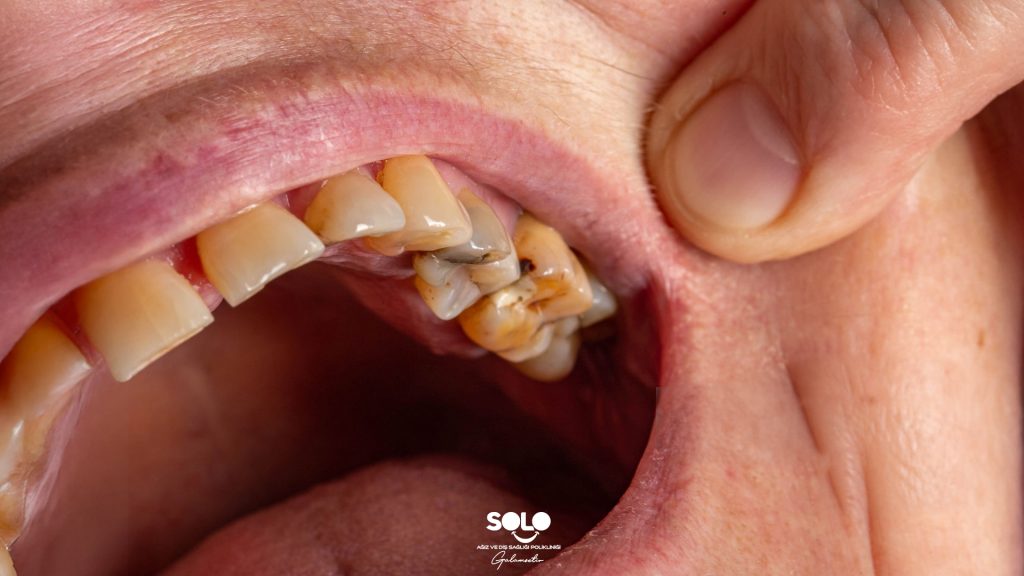 Çürük Diş Ağrısı Nasıl Geçer