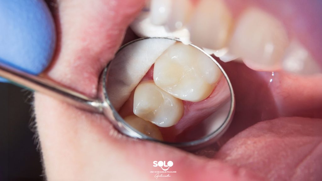 How Long Does a Dental Filling Last