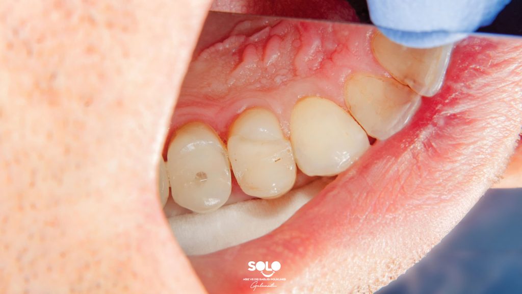 How Long Does a Dental Filling Last