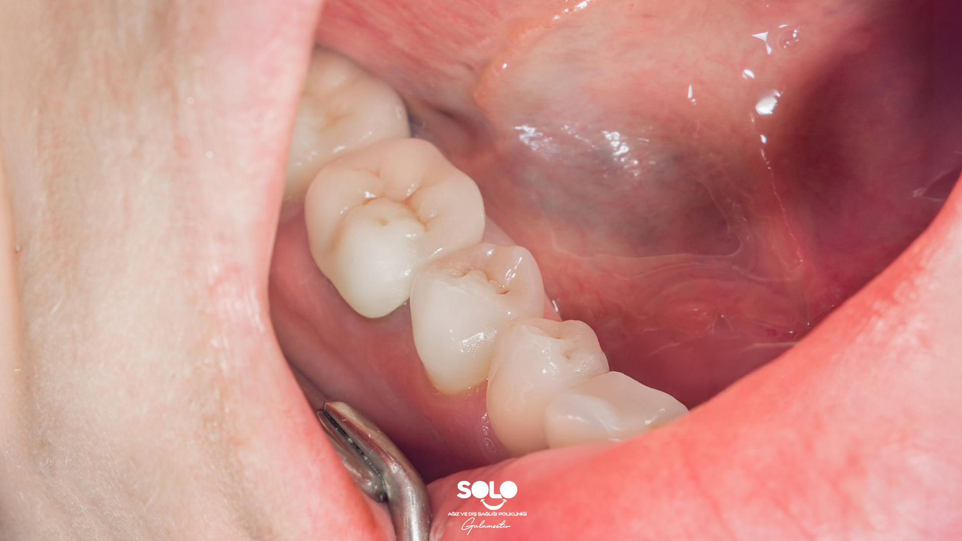 Diş Dolgusunun Ömrü Ne Kadardır