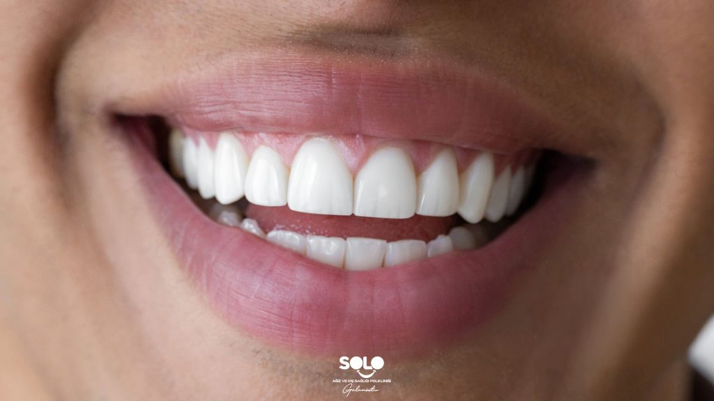 How Long Does a Dental Filling Last