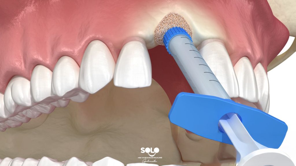 What Is Bone Grafting
