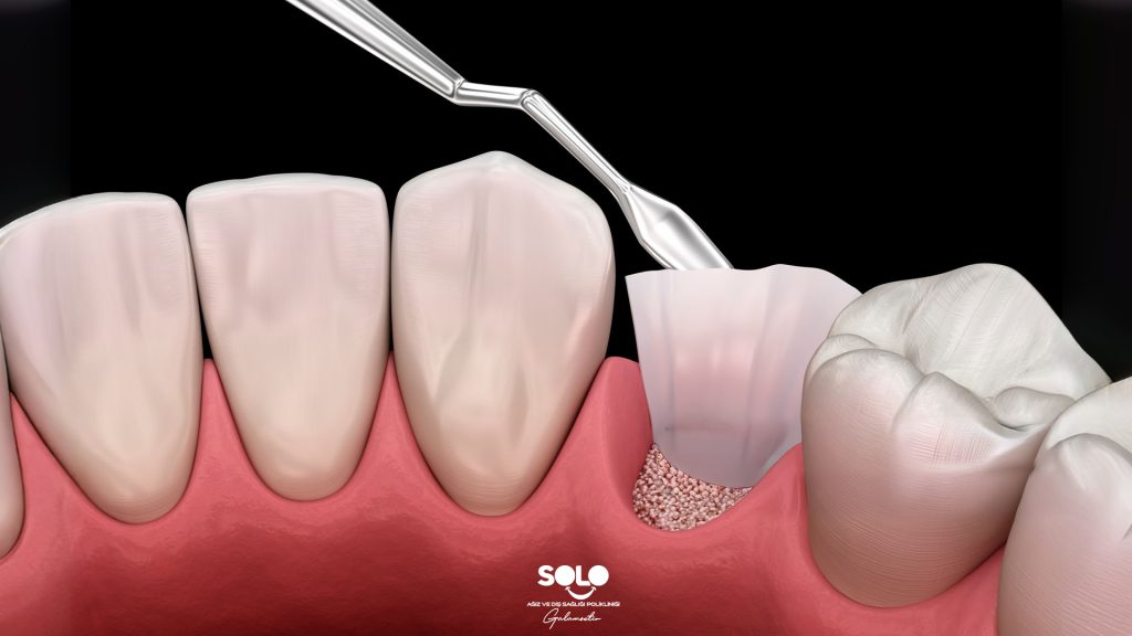What Is Bone Grafting