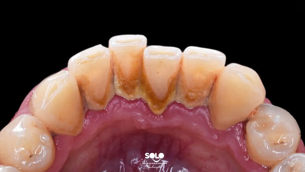 How Does Tartar Form?