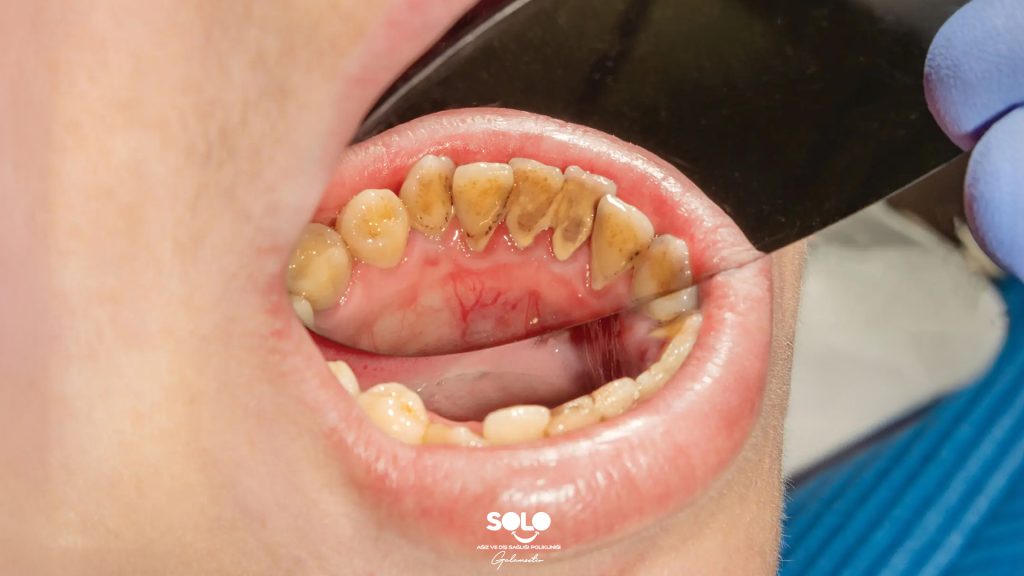 How Does Tartar Form?