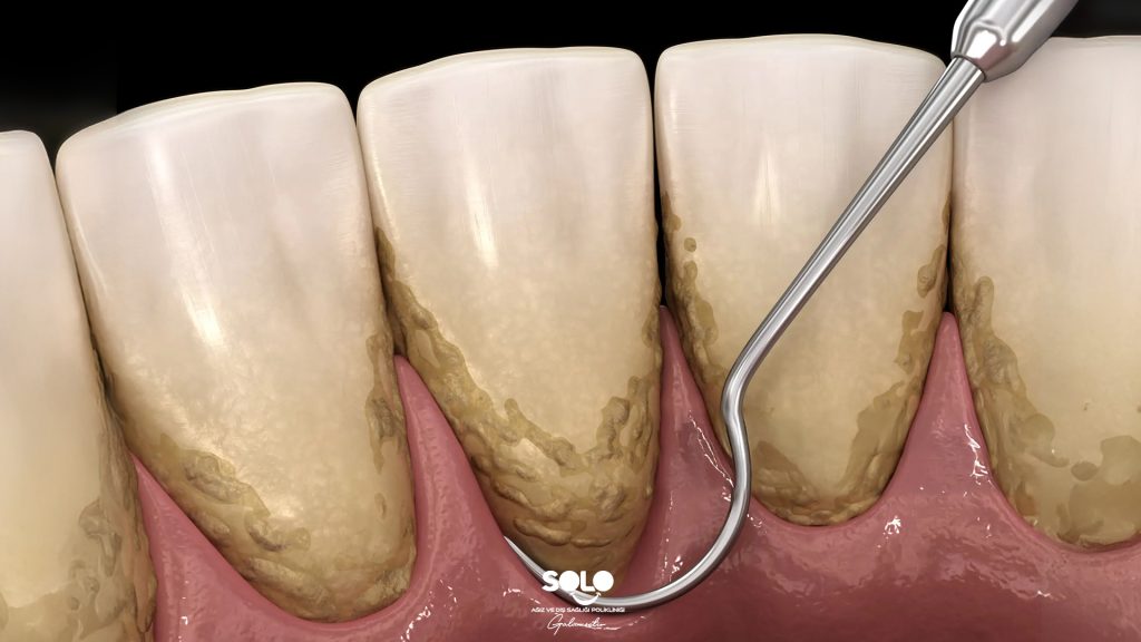 How Does Tartar Form?