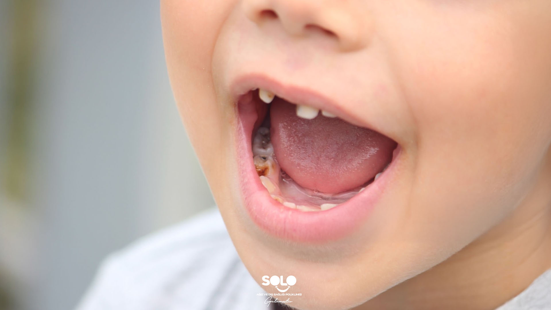 Süt Dişi Çürüğü Neden Olur