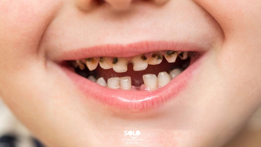 Why Do Baby Teeth Get Cavities