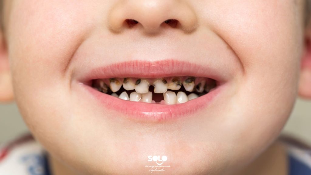 Why Do Baby Teeth Get Cavities