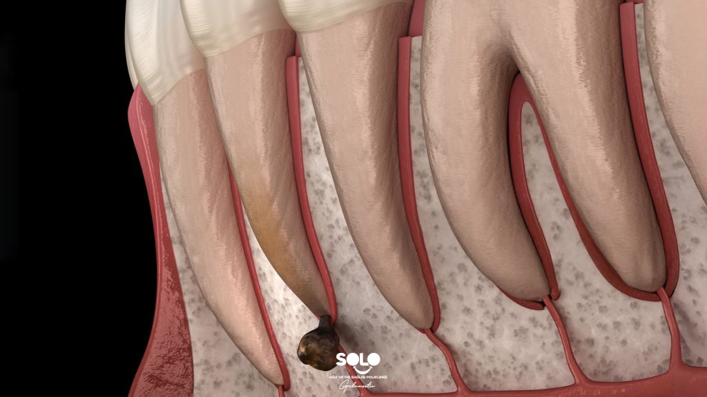 Apical Resection What Is It?