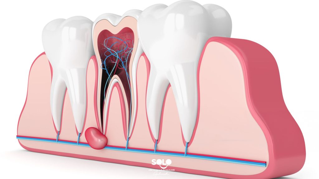 Apical Resection What Is It?
