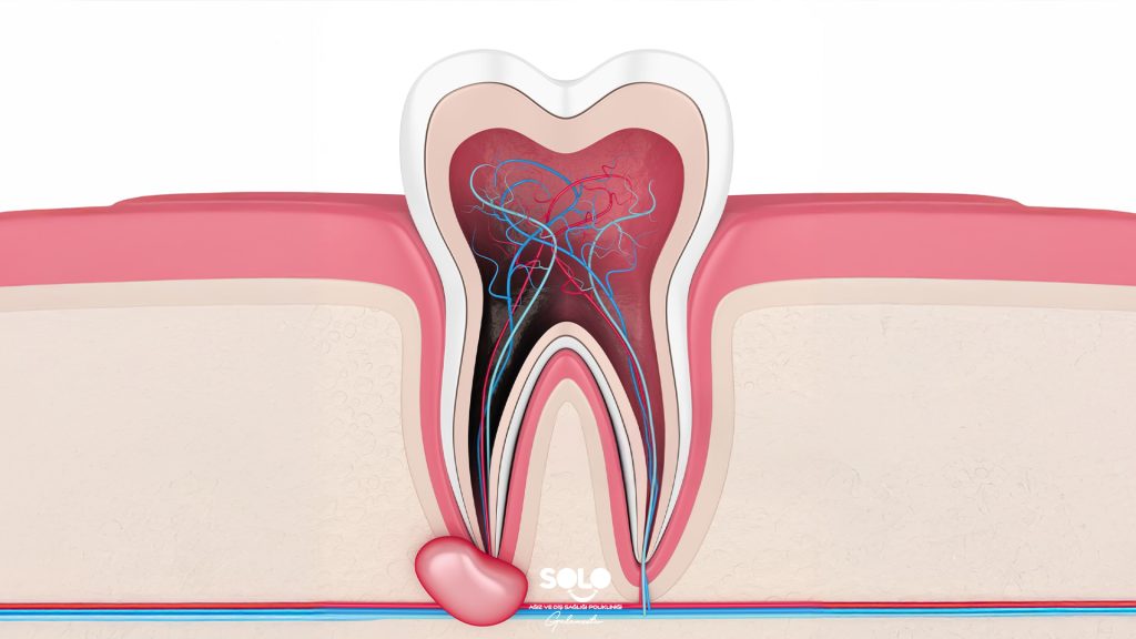 Apical Resection What Is It?