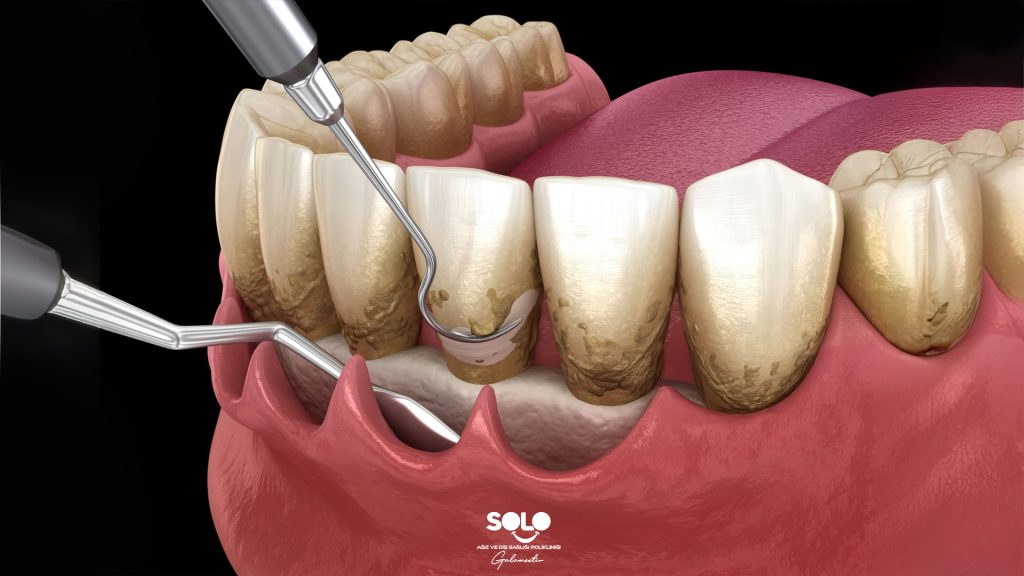 What Is Dental Curettage?
